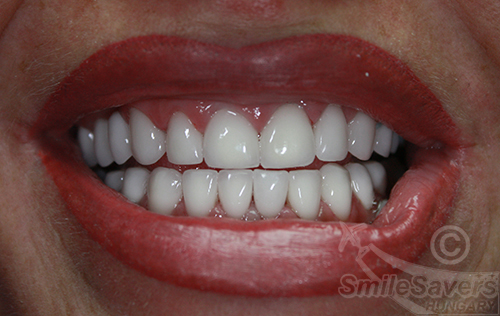 After treatment: Smile Makeover with Zircon Crowns