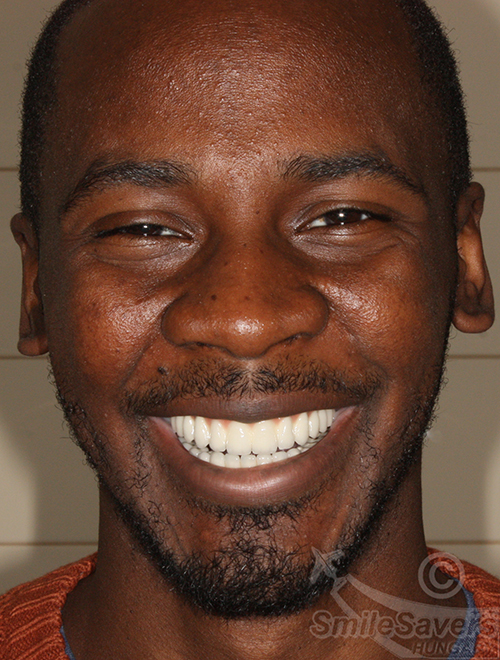 Additional photograph for Periodontal Disease and Collapsed Bite: A Full-Mouth Rehabilitation