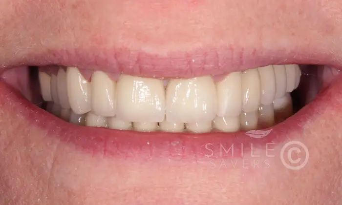After treatment: Smile Makeover with Zircon Crowns And Dental Implants