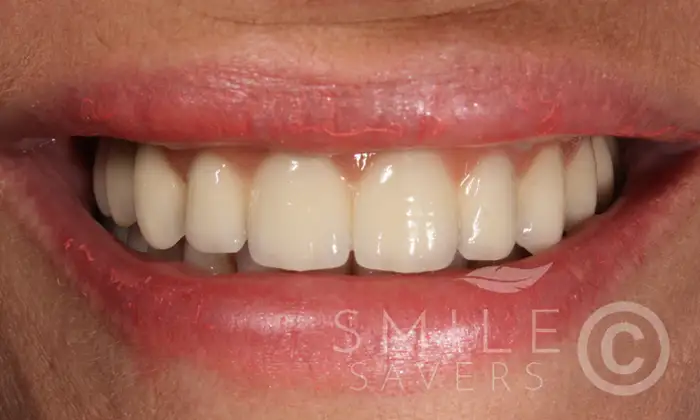 After treatment: Dental implants with Pink Porcelain Topped Crowns