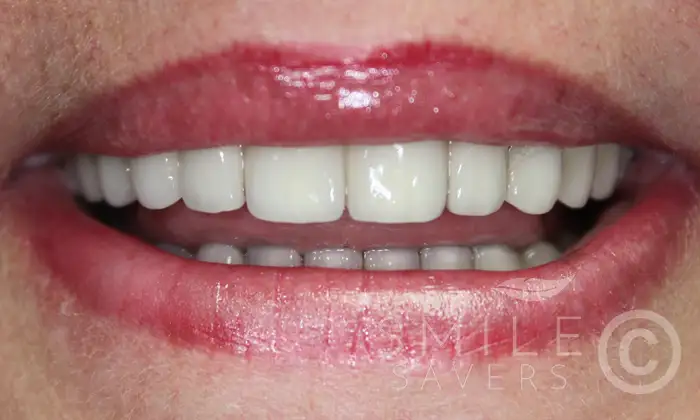 After treatment: All-on-4 & All-on-6 Dental implants