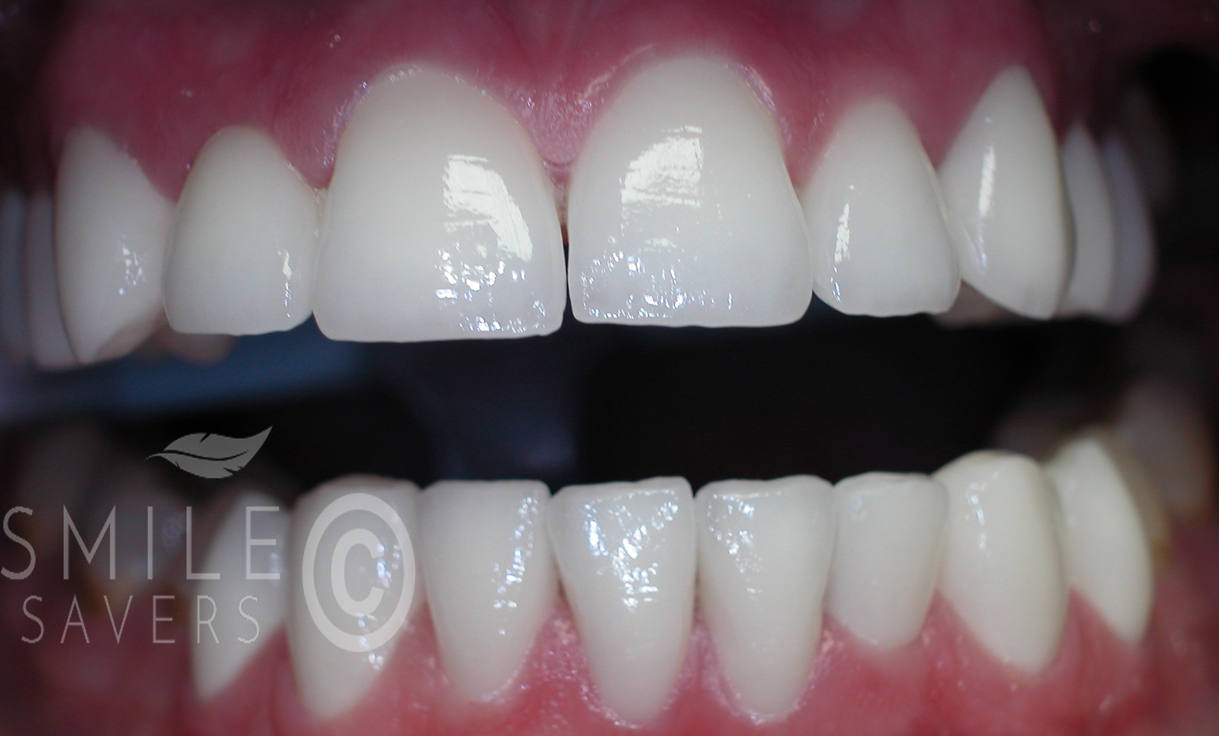 After treatment: Full Makeover with Zirconium Crowns