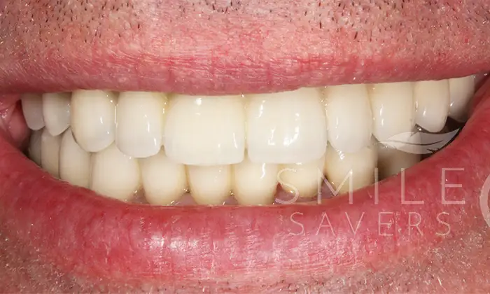 After treatment: All-on-6 dental implants with a porcelain bonded bridge and crowns