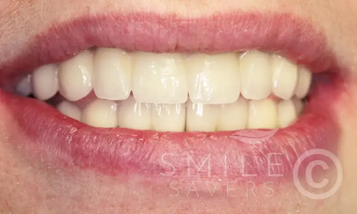 After treatment: All-on-6 implants in the upper jaw, lower single implants and dental crowns