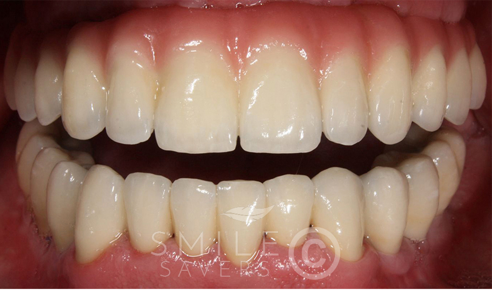 Additional photograph for All-on-6 dental implants with a porcelain bonded bridge and crowns