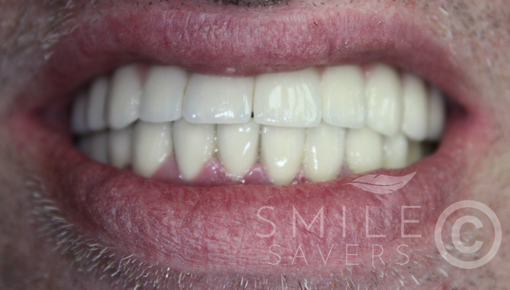 After treatment: All-on-6 Upper jaw treatment and lower implants and crowns