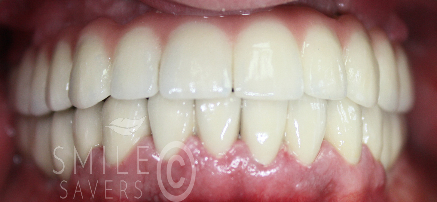 Additional photograph for All-on-6 Upper jaw treatment and lower implants and crowns