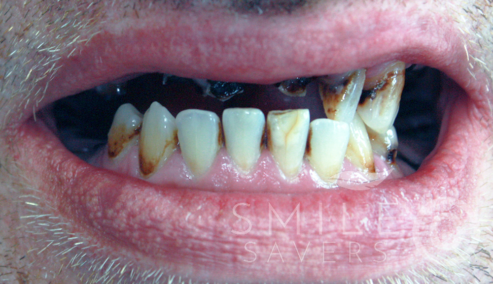 Before treatment: All-on-6 Upper jaw treatment and lower implants and crowns