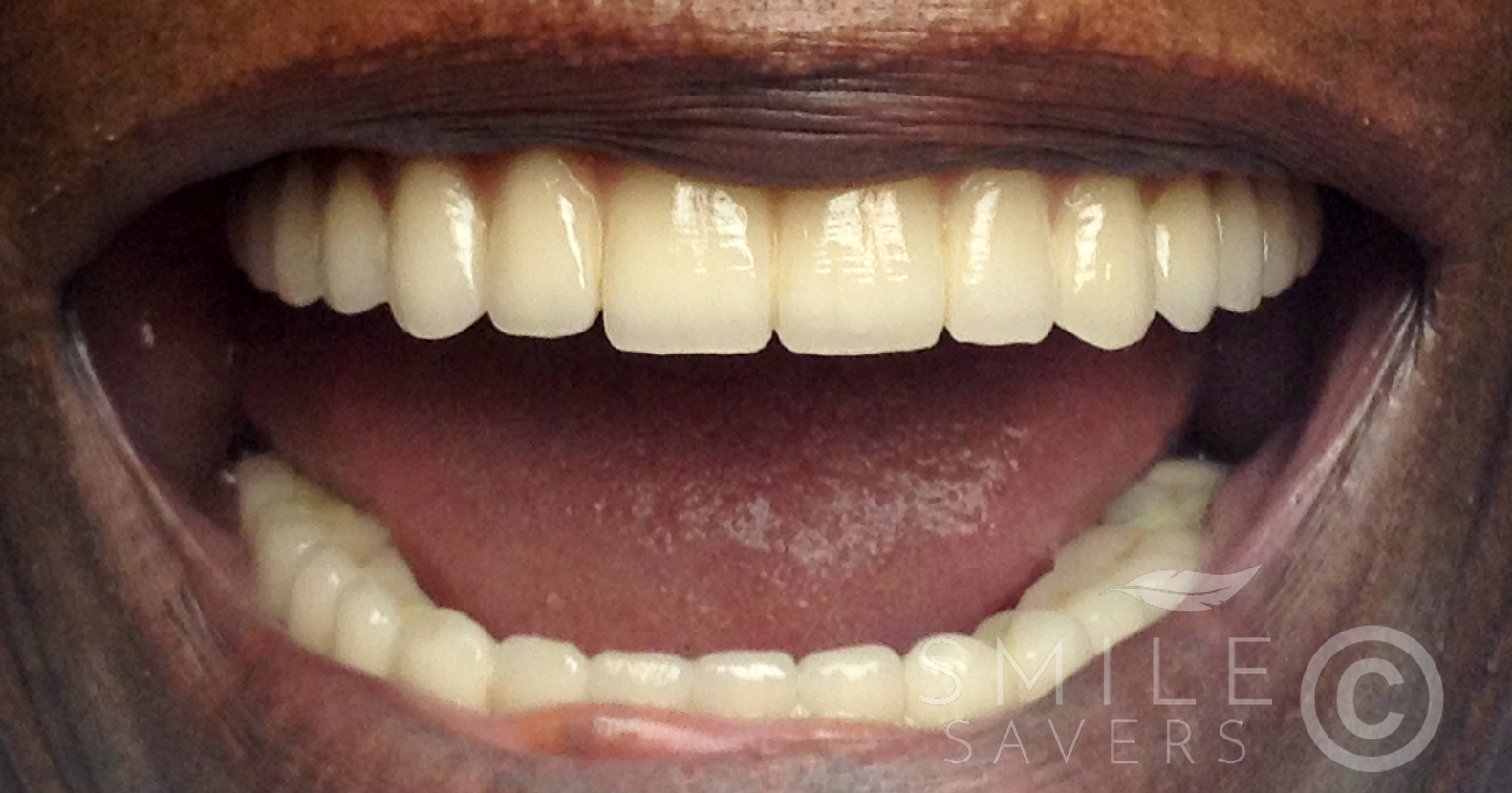 After treatment: Full mouth makeover with all-on-6 dental implants 