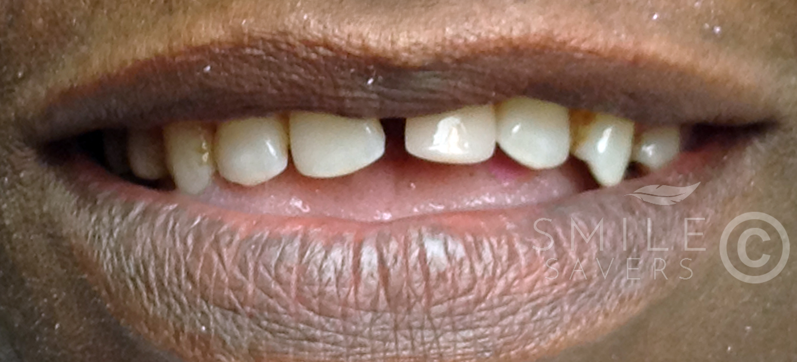 Before treatment: Full mouth makeover with all-on-6 dental implants 