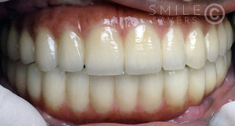 Additional photograph for Full mouth makeover with all-on-6 dental implants 