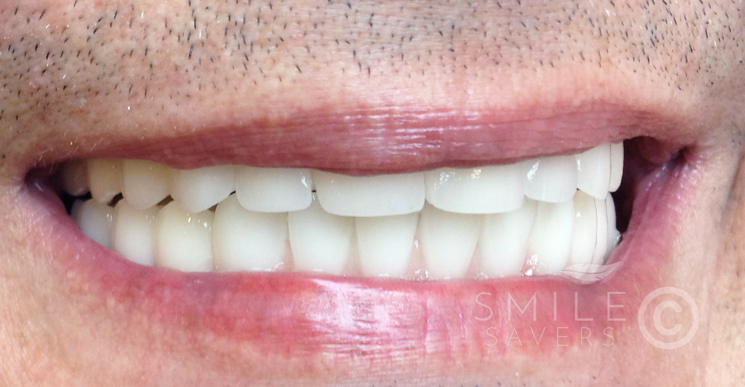 After treatment: All on 6 and all on 4 full mouth dental implants