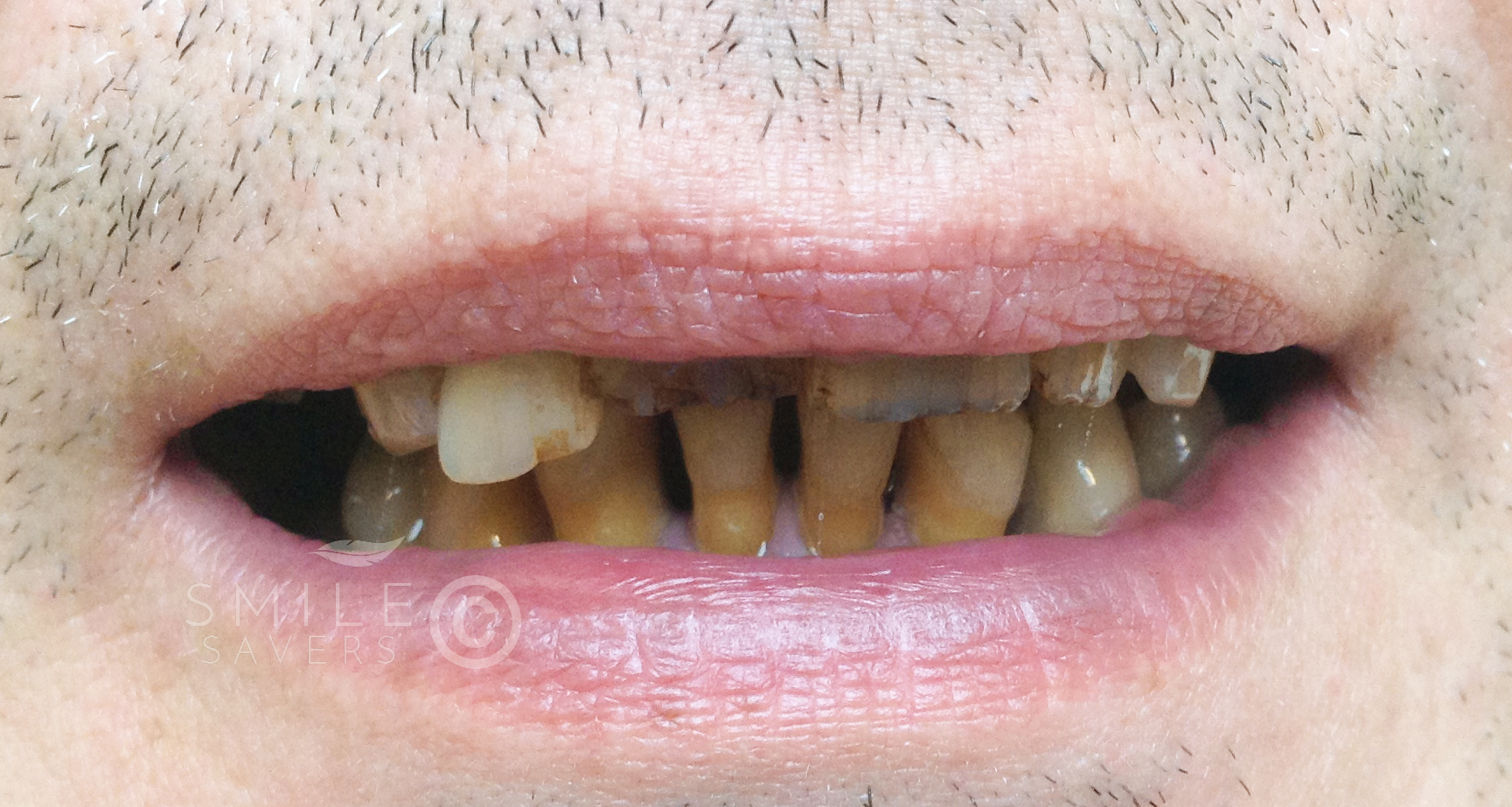 Before treatment: All on 6 and all on 4 full mouth dental implants