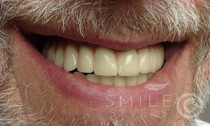 After treatment: All On Six Smile Transformation