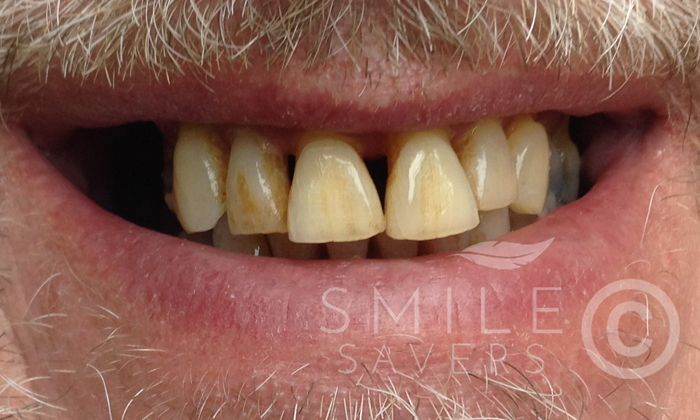 Before treatment: All On Six Smile Transformation