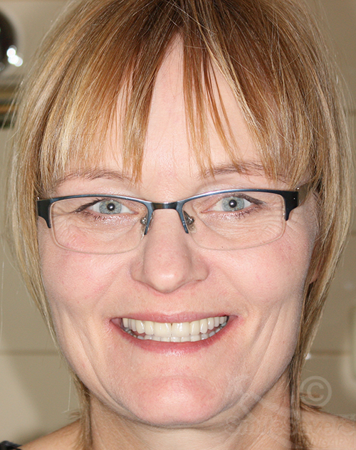 Additional photograph for Smile Makeover with Zircon Crowns And Dental Implants