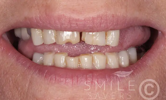 Before treatment: Smile Makeover with Zircon Crowns And Dental Implants