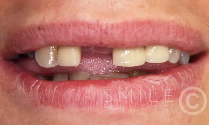 Before treatment: All-on-6 implants in the upper jaw, lower single implants and dental crowns
