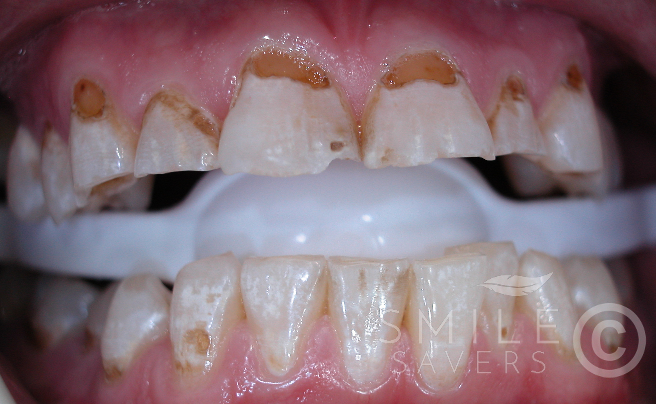 Before treatment: Full Makeover with Zirconium Crowns