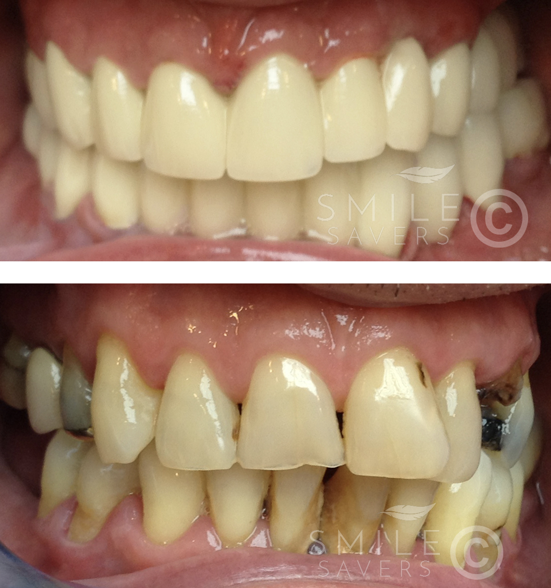 Additional photograph for Smile Makeover With Dental Crowns and Dental Implants