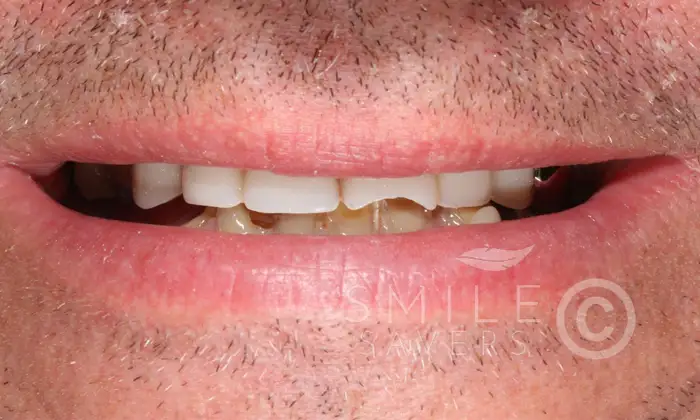 Before treatment: All-on-6 dental implants with a porcelain bonded bridge and crowns