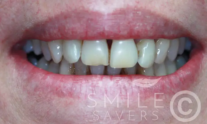 Before treatment: All-on-4 & All-on-6 Dental implants