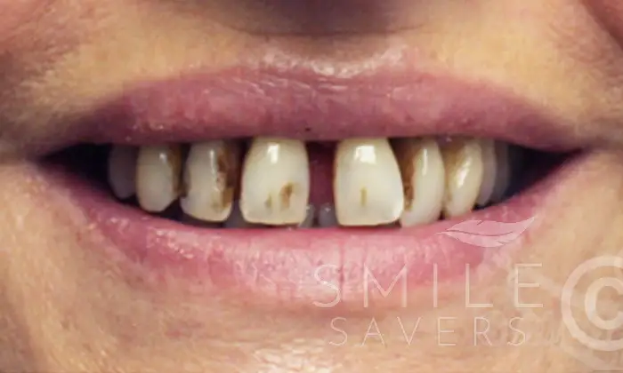Before treatment: Dental implants with Pink Porcelain Topped Crowns
