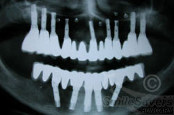 Additional photograph for Extensive Rehabilitation with Dental Implants