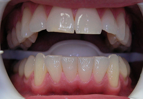 Before treatment: Smile Makeover With Porcelain Veneers