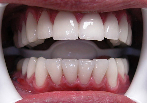 After treatment: Smile Makeover With Porcelain Veneers