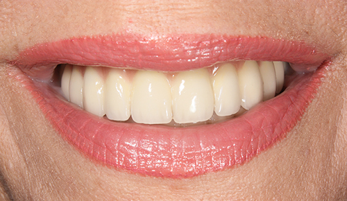After treatment: Full Smile Restoration After Advanced Gum Disease