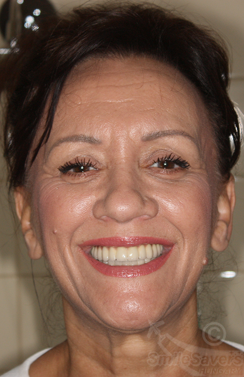 Additional photograph for Full Smile Restoration After Advanced Gum Disease