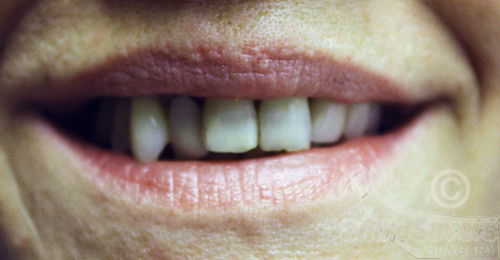 Before treatment: Full Smile Restoration After Advanced Gum Disease