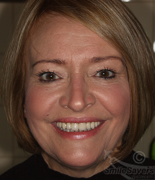 Additional photograph for Dental implants with Pink Porcelain Topped Crowns