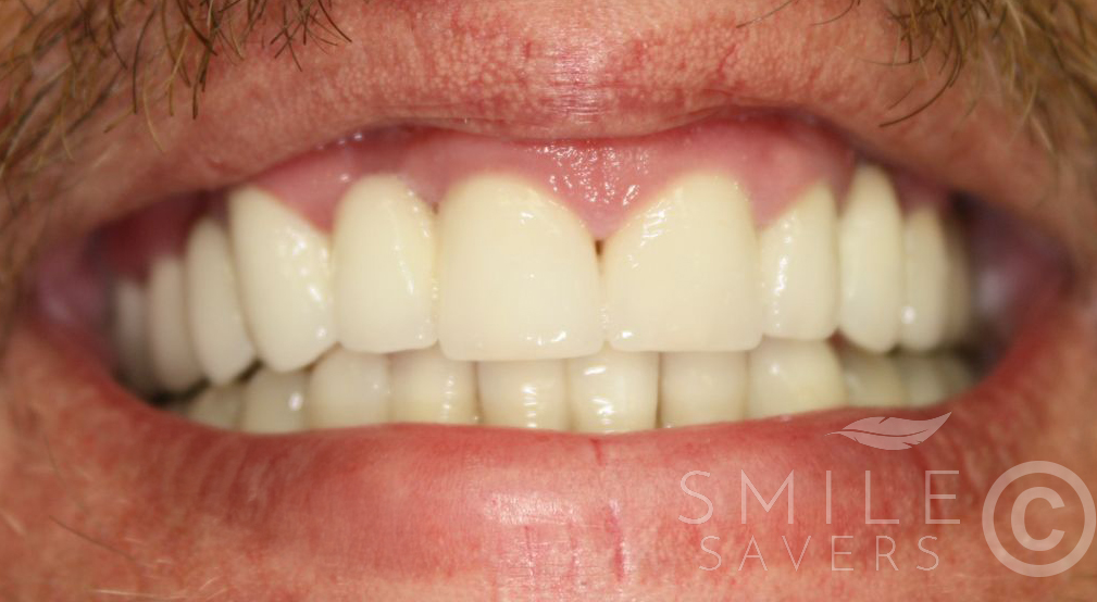 After treatment: Smile Makeover with crowns and bridges 