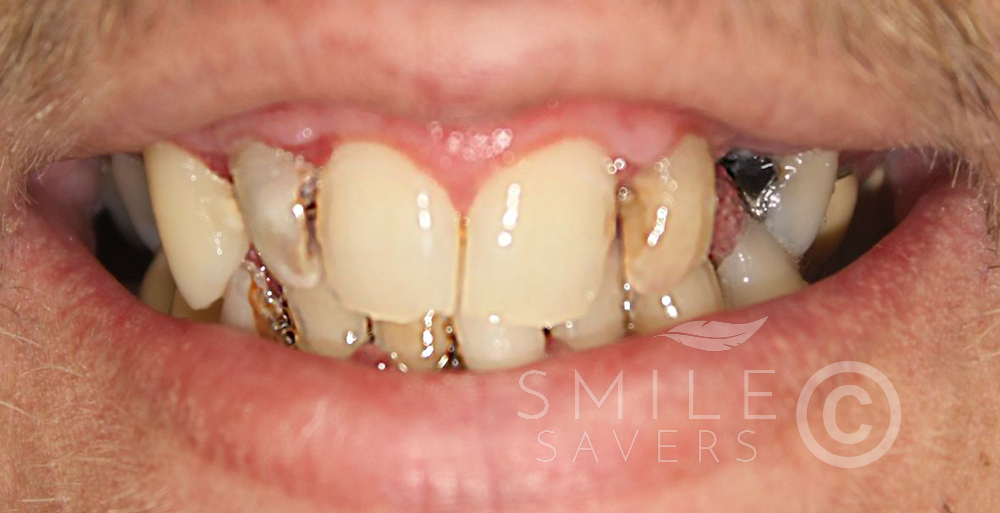 Before treatment: Smile Makeover with crowns and bridges 