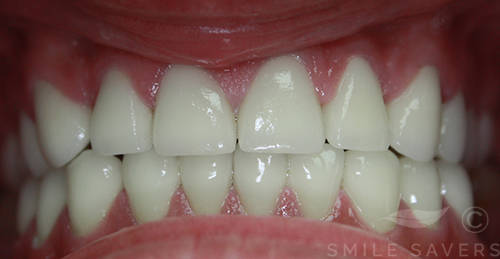 Additional photograph for Makeover with Zirconium Crowns