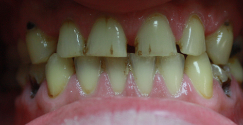 Additional photograph for Makeover with Zirconium Crowns