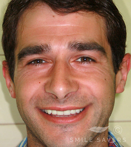 After treatment: Makeover with Zirconium Crowns