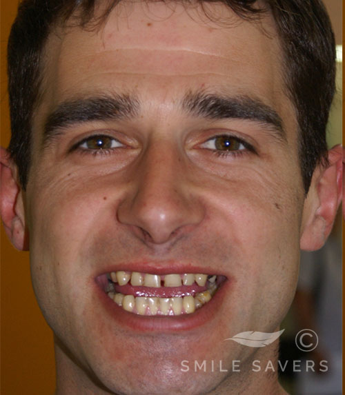 Before treatment: Makeover with Zirconium Crowns