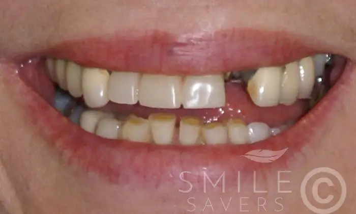 Before treatment: Dental Implants with Fixed Bridges