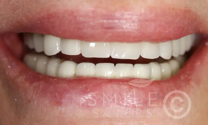 After treatment: Dental Implants with Fixed Bridges
