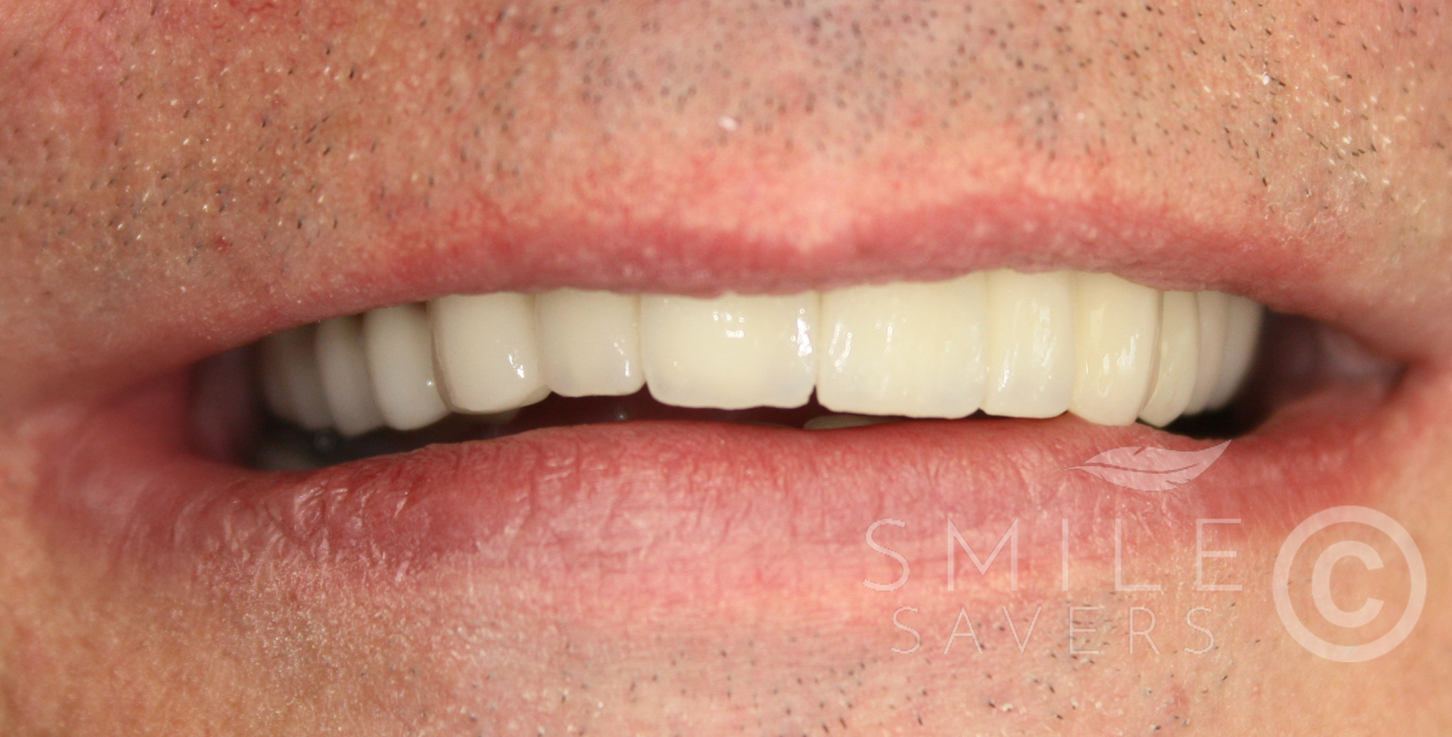 After treatment: Smile Makeover with Zirconium & porcelain bonded crowns/bridges and dental implants