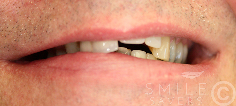 Before treatment: Smile Makeover with Zirconium & porcelain bonded crowns/bridges and dental implants