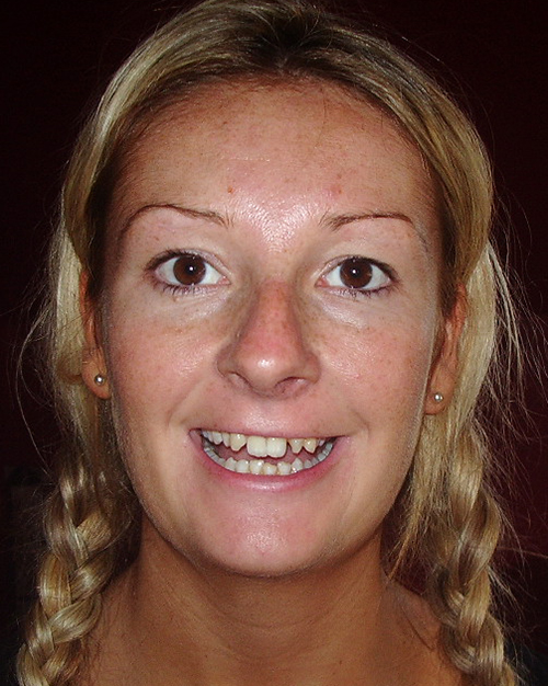 Before treatment: Makeover with crowns and bridges