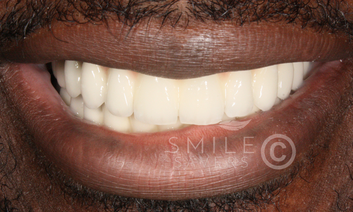 After treatment: Periodontal Disease and Collapsed Bite: A Full-Mouth Rehabilitation
