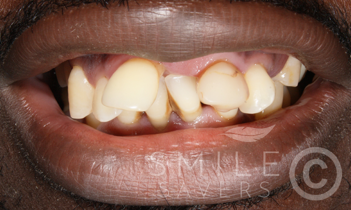 Before treatment: Periodontal Disease and Collapsed Bite: A Full-Mouth Rehabilitation