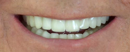 After treatment: Smile Makeover With Metal Free Zirconium Crowns