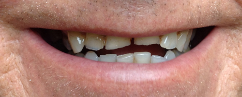 Before treatment: Smile Makeover With Metal Free Zirconium Crowns