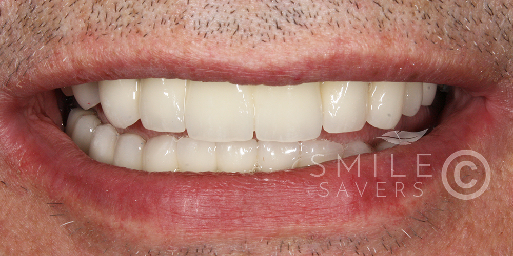 After treatment: Porcelain bonded bridges